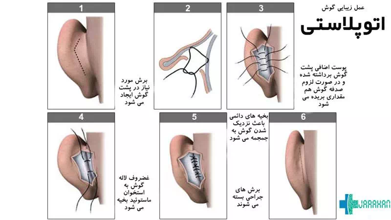 روش انجام عمل اتوپلاستی